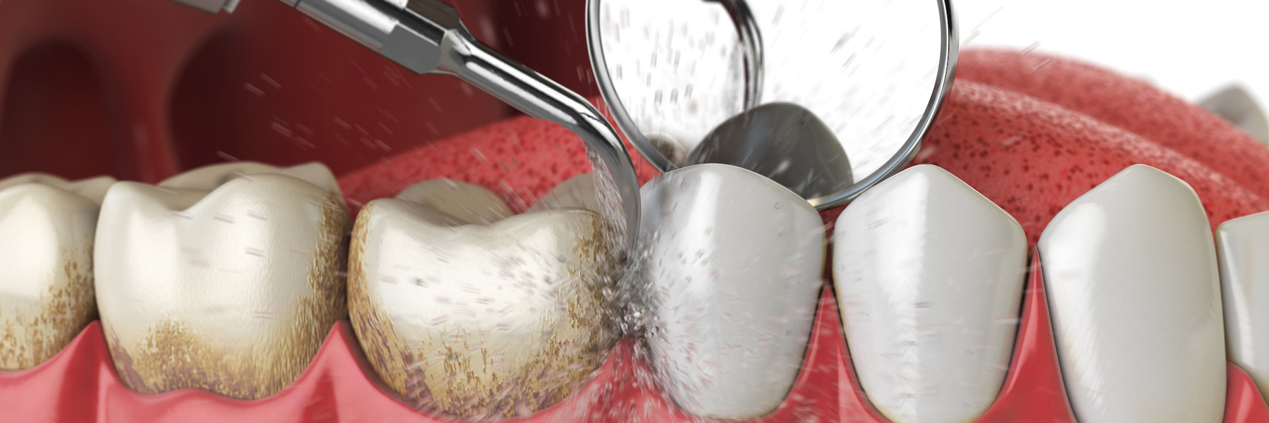 Teeth being cleaned, indianapolis indiana