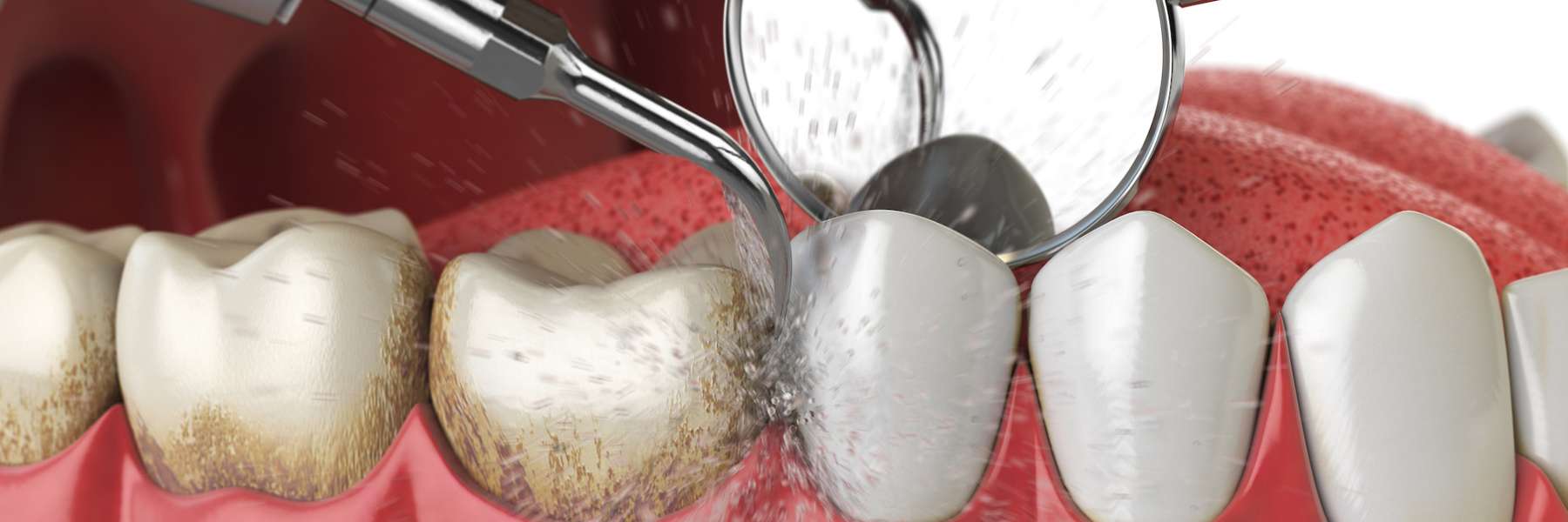 Teeth being cleaned, indianapolis in